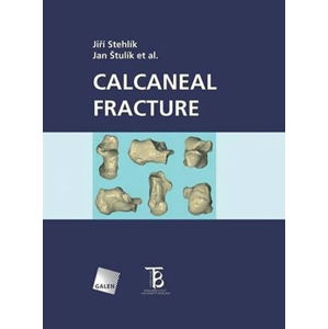 Calcaneal fracture - Štulík Jan